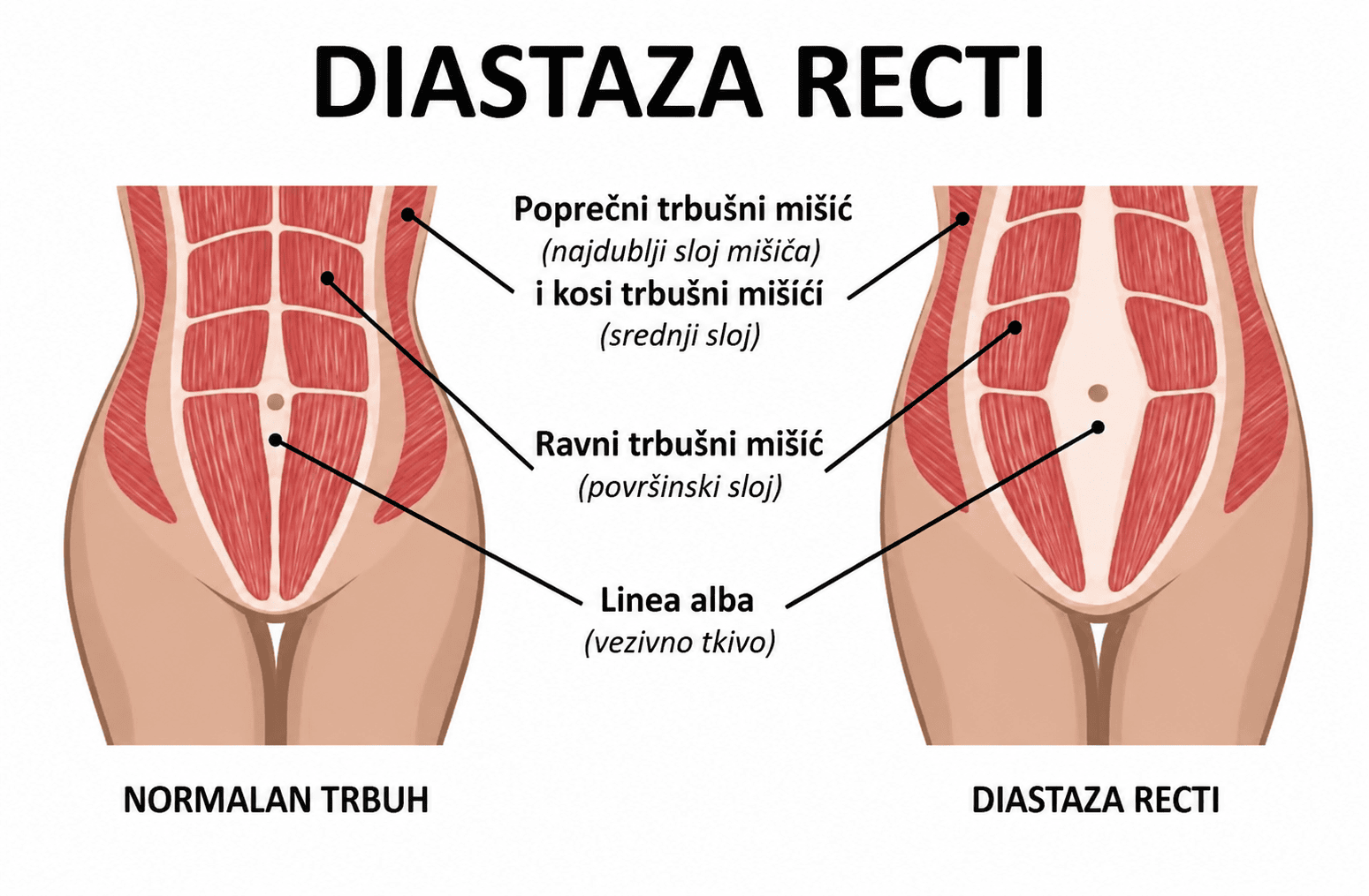 Anatomski prikaz: usporedba normalnog trbuha i dijastaze rectusa, s lineom albom te ravnim, kosim i poprečnim trbušnim mišićima